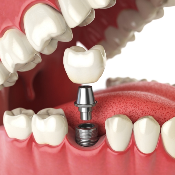 Illustration of a missing lower tooth being replaced with a dental implant and a dental crown