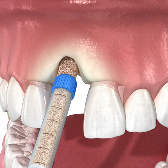 Illustration of bone grafting material being applied to the upper jaw where a tooth is missing