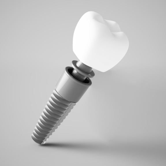 Illustration of a dental implant with a crown