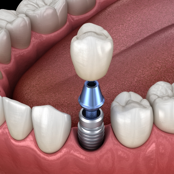 Illustration of a dental implant with a crown replacing one missing tooth