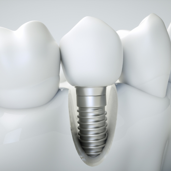 Illustration of a dental implant in the lower jawbone replacing a missing tooth