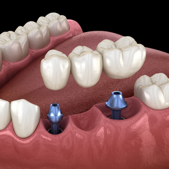 Illustration of two dental implants supporting a dental bridge to replace three consecutive missing teeth
