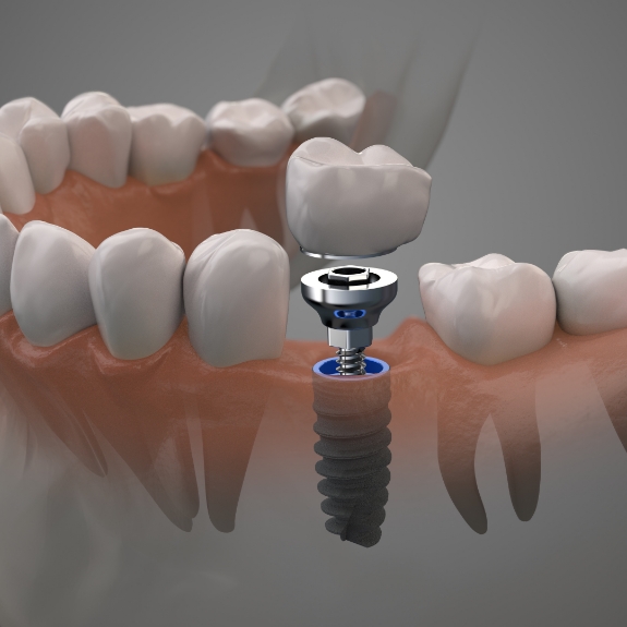 Illustration of a dental crown being placed over a dental implant in the lower jaw