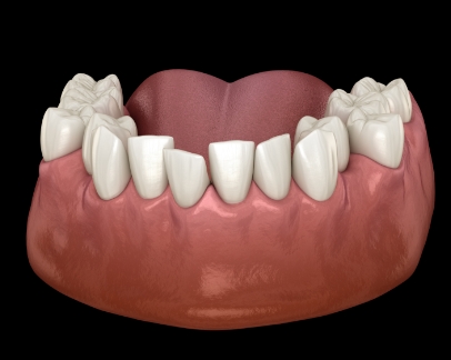 Illustration of a mouth with crowded teeth