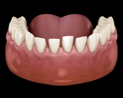 Illustration of a mouth with gapped teeth