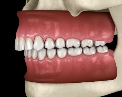 Illustration of a mouth with an overbite