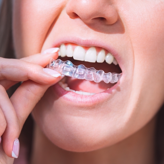 Close up of a woman placing an Invisalign tray over her teeth