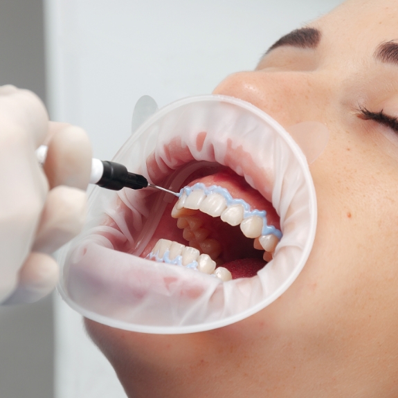 Dental patient having KOR teeth whitening gel applied to their teeth
