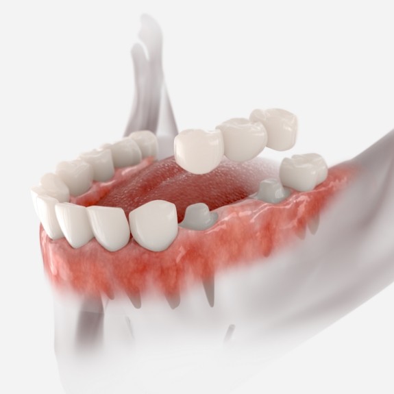 Illustration of a dental bridge being placed over two teeth to fill the gap between them