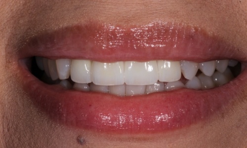 Close-up of smile with veneers covering worn teeth