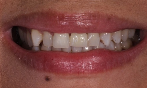 Closeup of before Long Island Crowns and Veneers