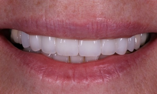 Closeup of after Long Island Smile Makeover