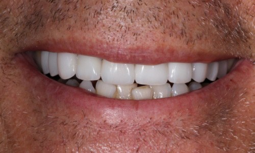 Close-up of smile improved with all-porcelain dental crowns