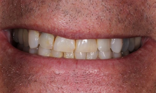 Close-up of Rick's discolored and worn-down teeth