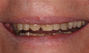 Closeup of woman's smile before treatment