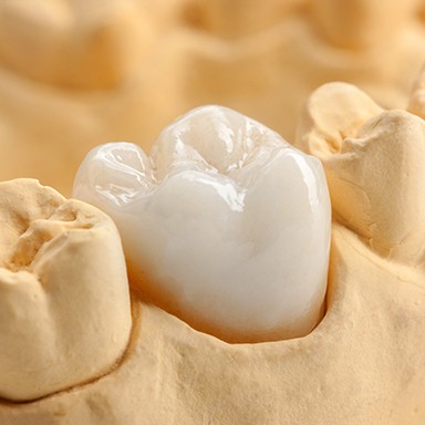 Closeup of model tooth with dental crowns