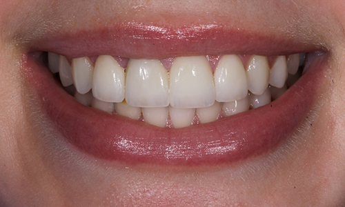 Closeup of patient after porcelain veneers