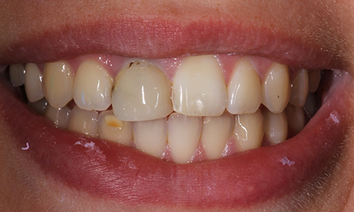 Closeup of patient before Long Island porcelain veneers