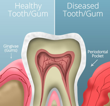 Animation of healthy and unhealthy gums