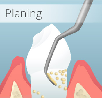Animation of root planing treatment