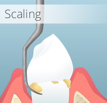 Animation of scaling treatment