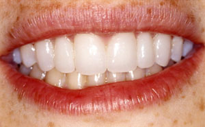 Smile with fixed bridges replacing teeth