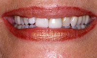 Older woman's flawed teeth before treatment