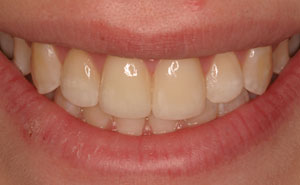 Closeup flawlessly repaired front top teeth