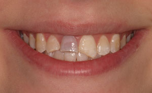 Closeup damaged front top teeth