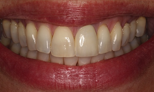 Front tooth replaced with porcelain crown to match natural tooth