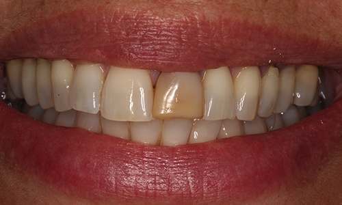 Before image of a discolored, crooked front tooth