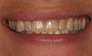 Closeup of discolored front teeth