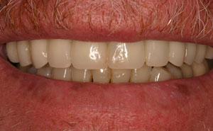 Closeup of healthy evenly spaced teeth