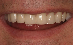 Closeup of beautiful smile after treatment