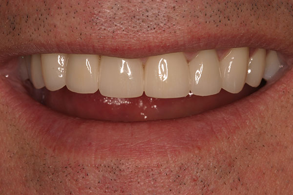 Closeup of beautiful smile after treatment
