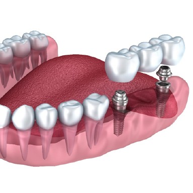 Model of a dental implant bridge in Long Island