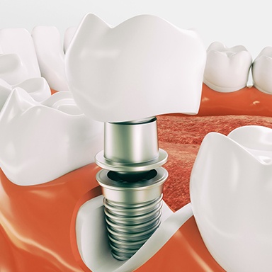 Animation of dental implant crown