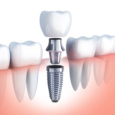 Animation of dental implant retained crown