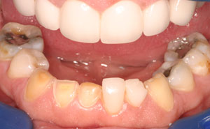 Closeup of damaged bottom teeth