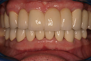 Senior man teeth and gums closeup after full mouth reconstruction