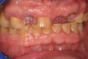 Senior man teeth and gums closeup before full mouth reconstruction