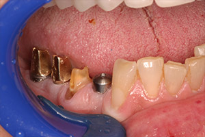 Closeup bottom teeth with implants in place