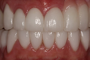 Closeup bottom teeth with restorations in place