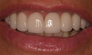 Closeup of gorgeous smile after full mouth reconstruction