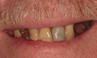 Senior man patient closeup before full mouth reconstruction