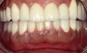 Flawless healthy smile after full mouth reconstruction