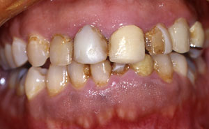 Damaged and decayed teeth closeup