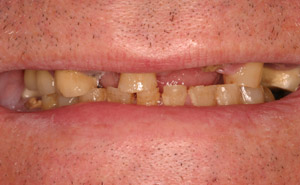 Before image of discolored and missing teeth