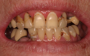 Closeup of severely damaged teeth