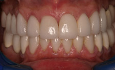 Closeup of white bottom teeth